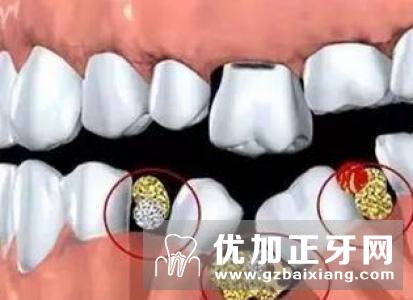 几种修复缺失牙的方法