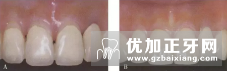 固定义齿修复中暂时修复体的作用