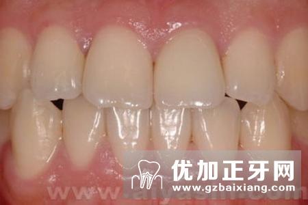 北京牙齿修复方式哪种比较好？