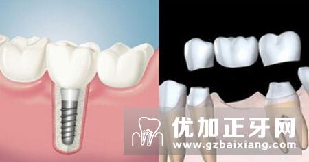修复牙齿缺失的方法有哪些