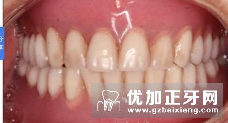 齿缺失的五个原因 牙齿缺失如何修复呢？