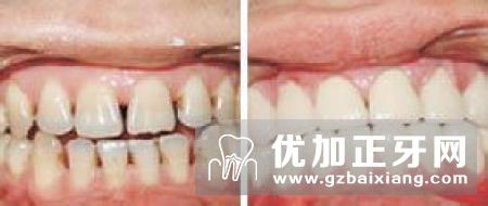 活动假牙和固定假牙有什么区别？