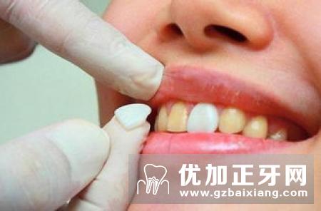 北京牙齿修复方式哪种比较好？