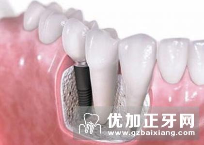 种植牙是缺牙修补的首选修复法