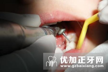 牙齿修复的好材料是什么