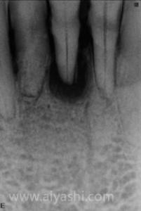 缺失牙种植牙应如何修复