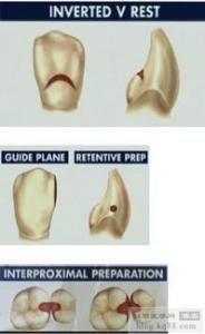 可摘局部义齿设计的基本要求