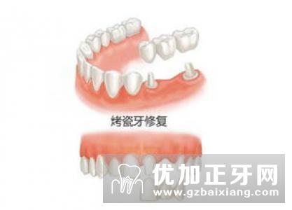 种植牙牙齿修复优点