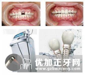 牙齿缺失有哪几种修复方法？