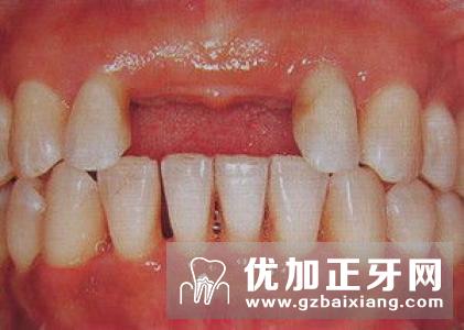 种植牙牙齿修复优点