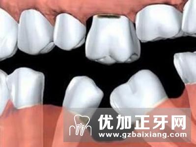 牙齿缺失有什么危害吗