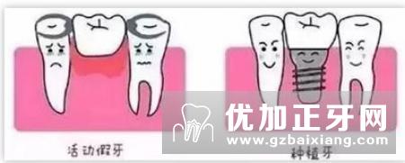 活动假牙和固定假牙有什么区别？