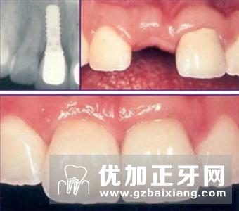 进行门牙缺失修复的方法哪种效果比较好?口腔种植牙门诊中心给予回复