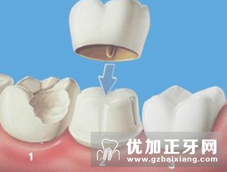 套筒冠义齿最好的假牙修复方法