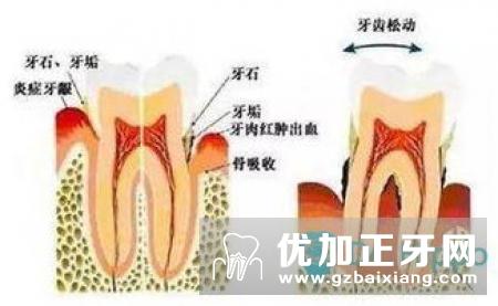 牙齿松动原因与治疗