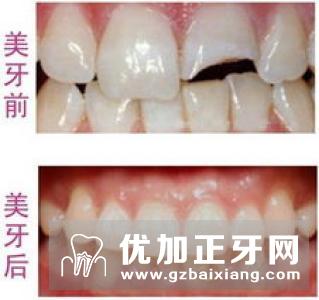 三种个别牙缺失的修复方法