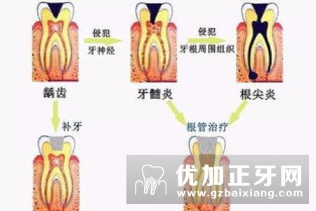 烤瓷牙为什么会造成牙龈炎？