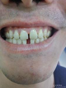 固定义齿修复后的龈炎问题