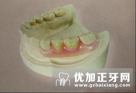 义齿如何清洗有市民反应自己佩戴的义齿还变色了,总感觉牙龈不舒服
