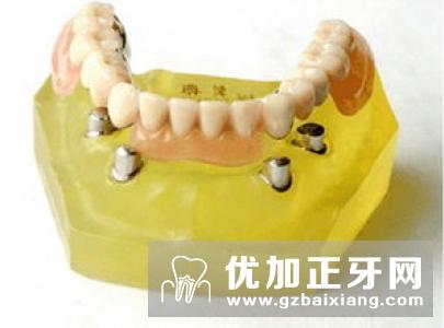 义齿都有哪些种类?活动义齿、全口义齿和种植义齿修复方法