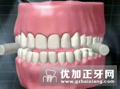 影响固定义齿修复的因素