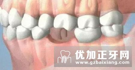 牙齿修复使用固定义齿有啥好?