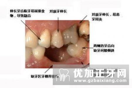 口腔修复X线检查-固定义齿