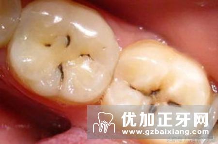 活动义齿相比，人工种植牙有哪些优点？