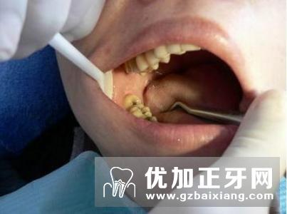 由于智齿生长的特殊位置,给它的清洁和治疗带来许多问题