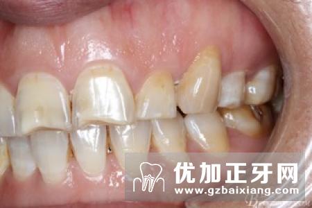 哪些因素会引起氟斑牙呢?