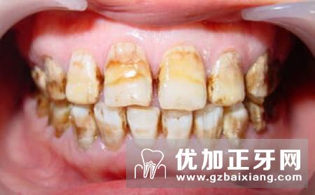 哪些因素会引起氟斑牙呢?