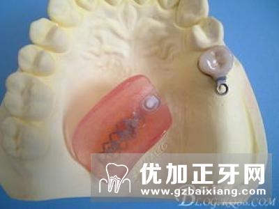 【精密附着体】义齿修复固位体形式