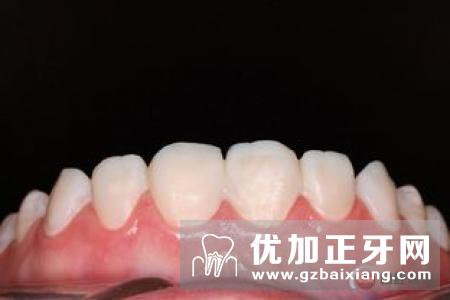 为什么会得氟斑牙？如何修复氟斑牙？