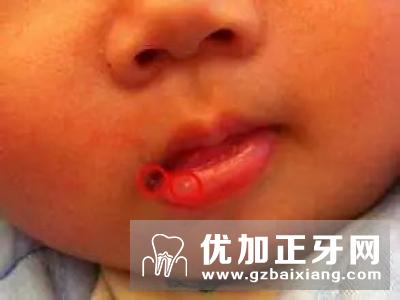 孩子口角炎的防治方法