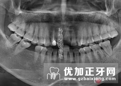 固定修复牙齿龈缘设计方法