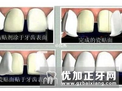 牙齿贴面修复能维持多久