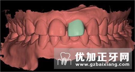 固定修复牙齿龈缘设计方法