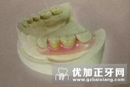 老年人可以装假牙的种类通常有哪些