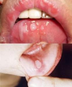 口腔溃疡该怎么治？