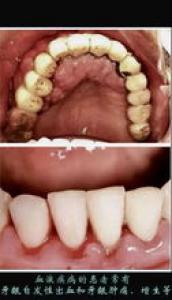 牙龈炎可以分为哪些种类呢
