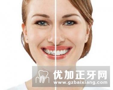牙齿修复中牙体修复种类有哪些？
