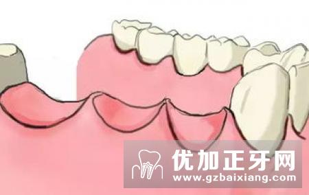 牙齿修复中牙体修复种类有哪些？