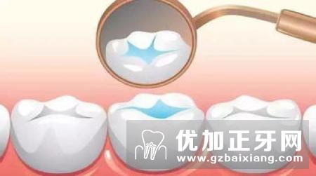 牙齿涂氟：小儿牙齿第一重防护