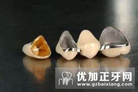 烤瓷牙对牙齿损伤大 患者应慎重选择