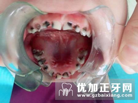 儿童乳牙出现虫牙需要治疗吗