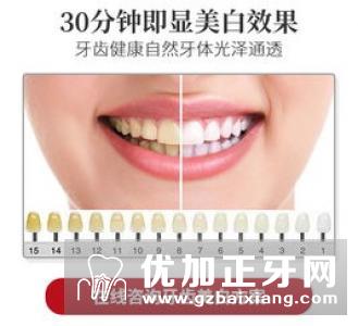 氟斑牙美白修复的方法有哪些